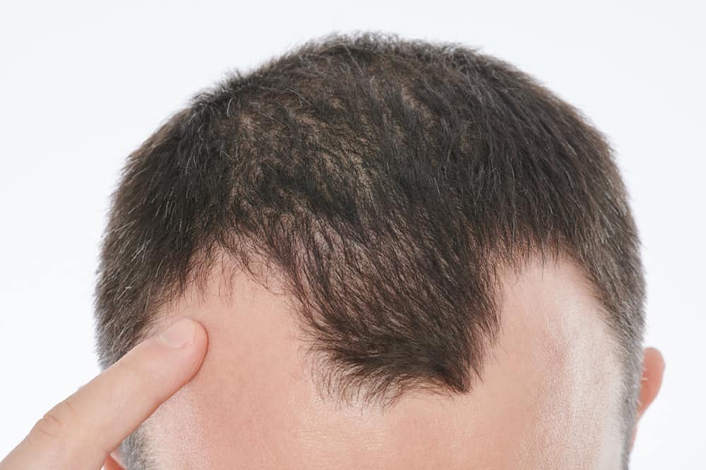 Arveligt hårtab (androgen alopeci)