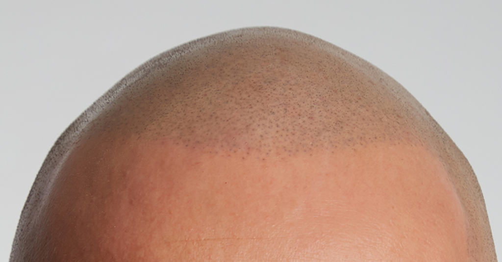 Scalp Micro Pigmentation (SMP)